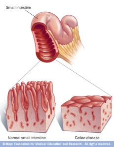 Celiac Disease Illustration